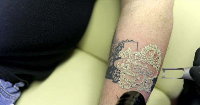 Tattoo Laser Treatments